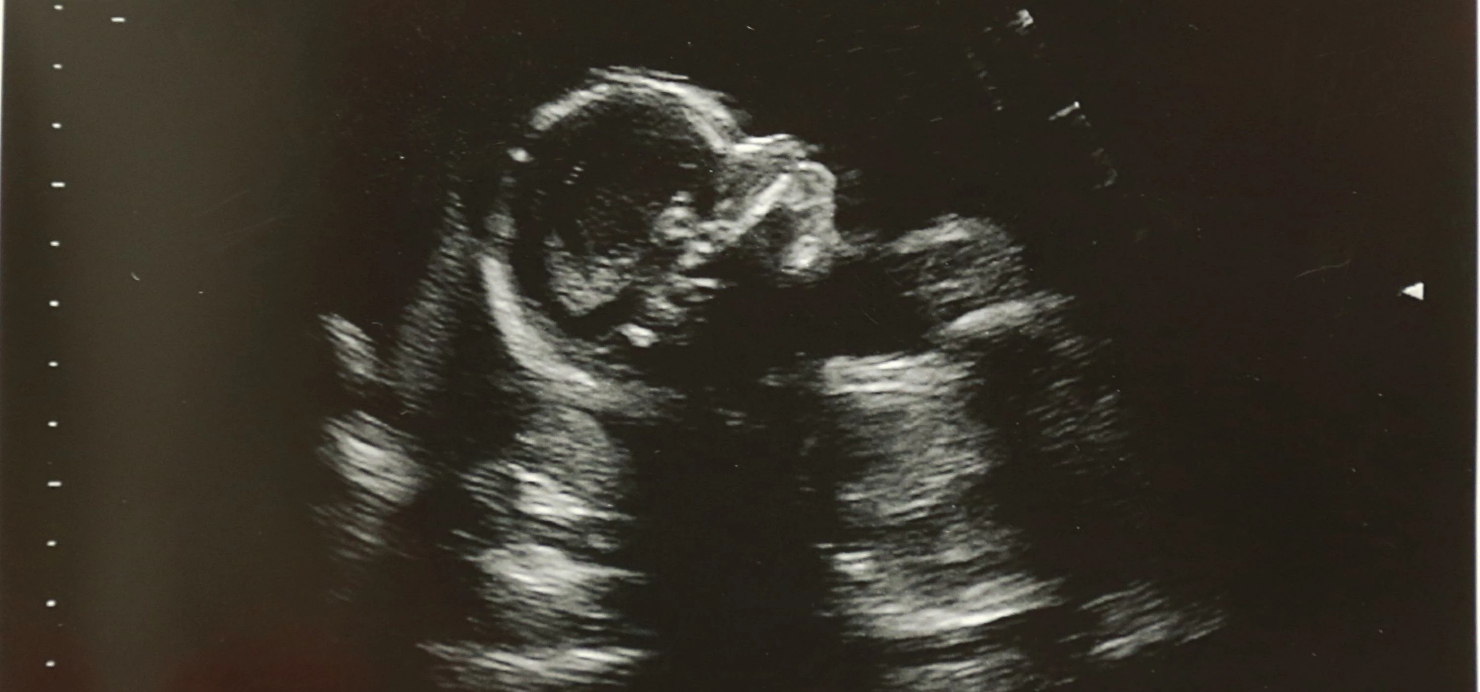 Ultrasound 1
