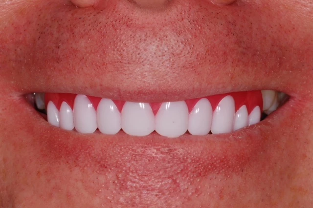 Richard Coates with fake teeth